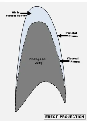 Foto lateral decubitus pada sisi yang sehat dapat membantu dalam membedakan pneumothorax dengan kista atau bulla