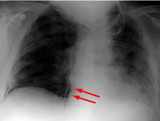 Gambar 7  Pneumothorax pada posisi supine (panah merah= posisi udara di tengah)