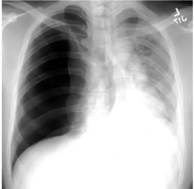 Gambar 10. Tension Pneumothorax Kanan dengan Pergeseran Mediastinum ke Kiri b Computed Tomography (CT) Scan