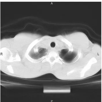 Gambar 12. Tampilan hasil CT Scan Pasien Pneumothorax
