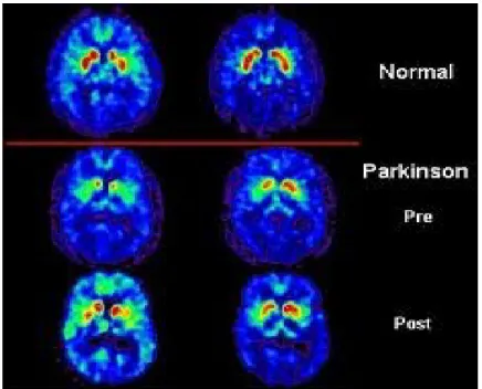 Gambar 3. PET pada Parkinson