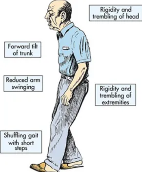 Gambar 4. Gambaran Klinis pada Penderita Parkinson