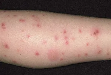 Gambar 14. Sumber: http://fleaexpert.com/flea-bites-on-humans-symptoms-and-treatment/