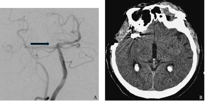 Fig. 3. Brain 3D CT angiography showing 3 remote  aneurysms: the left AChA and left MCA unruptured  aneurysms, and the right ICA (ophthalmic segment)  aneurysm, which was ruptured (arrows).