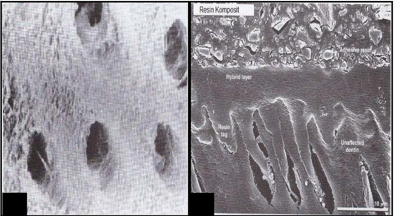 Gambar 7. Scanning Electron Microscopy  ruang intertubular dan  tubulus dentin yang terbuka sangat luas pada dentin yang dietsa (A)