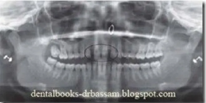 Gambar 6: Kehilangan Tulang Generalisata Pada Periodontitis Kronis Generalisata Gambaran radiografi