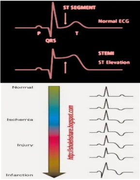 Gambar 1.  ECG Normal dan abnormal  (http://uchicagomed.files.wordpress.com) 