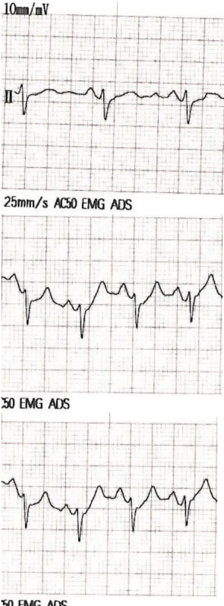 Gambar  4.  Sinyal ECG pada Exercise 0 –  5 – 15 menit  pada reponden HR 