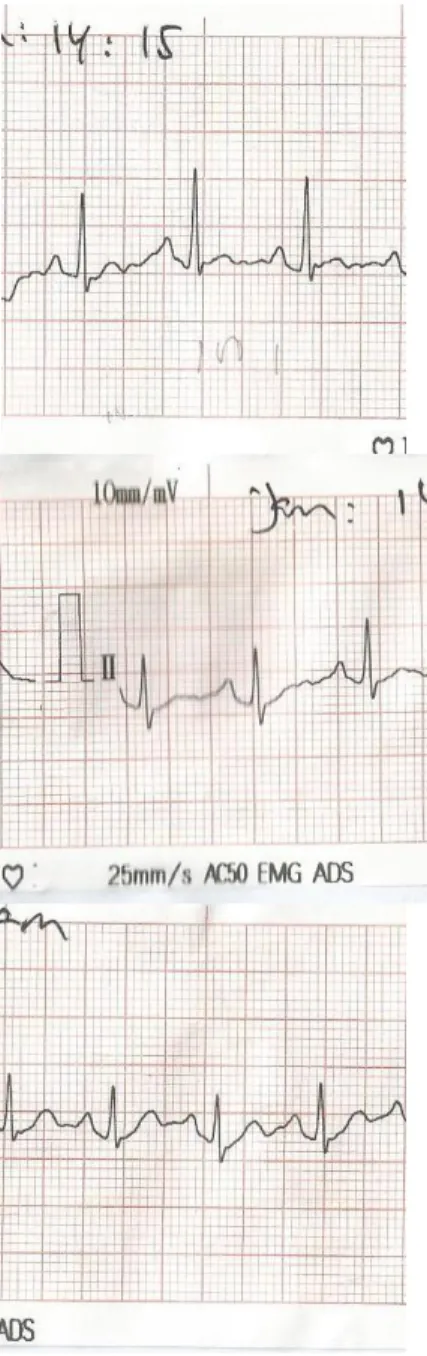 Gambar 7. Gambaran ST Elevasi sinyal  ECG pada Exercise 0 – 5 – 15 menit 