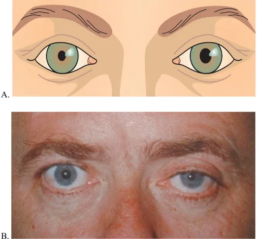 Gambar 9. Sindroma Horner pada mata kanan (A) dan mata kiri (B).