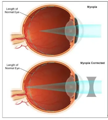 Gambar 2.3. Mata miopia dan koreksinya.17