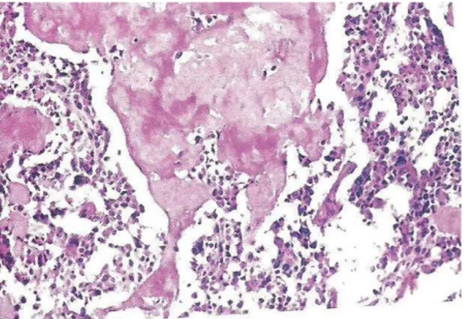 Gambar : Karsinoma medular tiroid. Tumor ini biasanya mengandung amiloid,  yang disini tampak sebagai bahan ekstrasel homogen, berasal dari molekul 