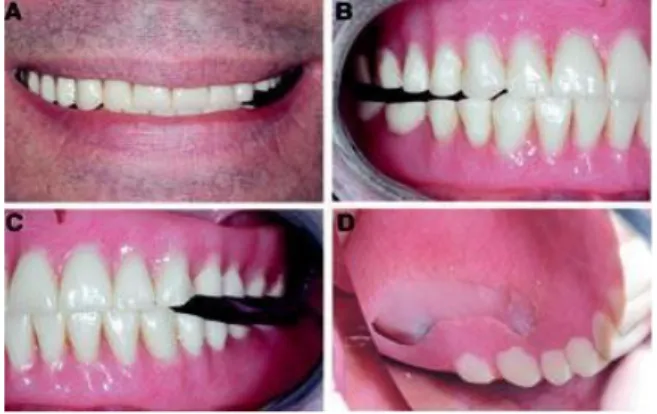 Gambar 1.  (A) Gigi anterior tidak mengalami abrasi dan mempertahankan   OVD.(B)   Abrasi   gigi mengakibatkan   kurangnya   oklusi   gigi posterior
