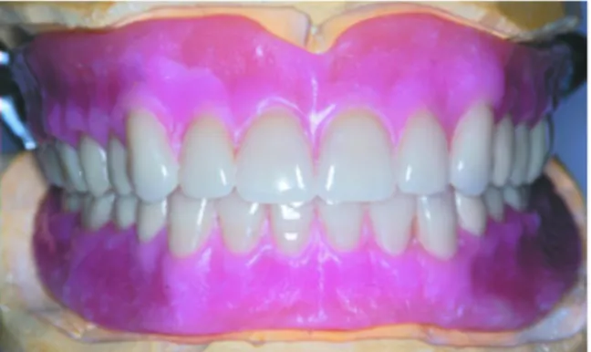 Gambar 3.  Segmen zirkonia berwarana seperti komposit untuk mencegah perubahan warna dengan resin   basis   gigi   tiruan   berwarna   pink.