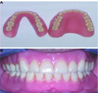 Gambar 8.  (A) Pada saat 8 bulan pemakaian , gigi tiruan   menunjukkan   hilangnya   kilau pada gigi tiruandaerah basis