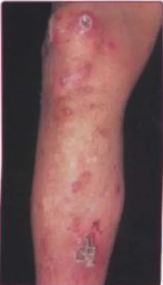Gambar 9. Gambaran klinis folikulitis