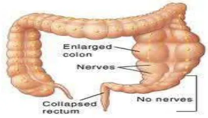 Gambar 2.3 Dilatasi kolon akibat tidak ditemukannya sel saraf pada bagian akhir usus 