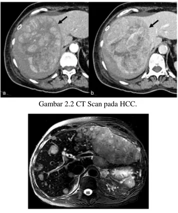 Gambar 2.2 CT Scan pada HCC. 
