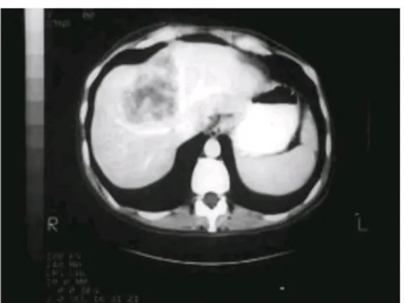 Gambar 2.4 CT Scan pada kanker hati sekunder yang berasal dari metastasis kanker kolon