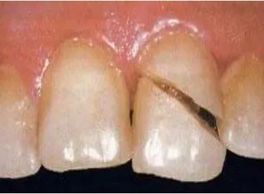 Tabel 1.Klasifikasi komplikasi pencabutan gigi berdasarkan gambaran klinis. 1 