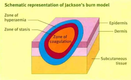 Gambar 8. Jackson’s burn model
