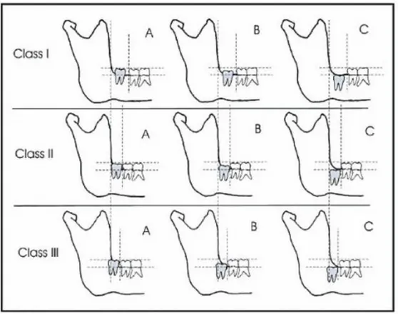 Gambar 2. Klasifikasi impaksi gigi molar ketiga menurut Pell &amp; Gregory.  2