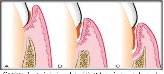 Gambar 1. Jenis-jenis poket. (A) Poket gingiva, belum ada kerusakan pada jaringan periodontal pendukung