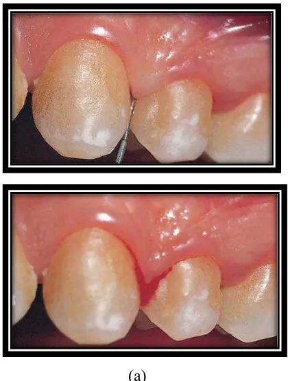 Gambar 2. Perdarahan saat probing (a) Probing pada gingiva yang mengalami oedematus akibat gingivitis, (b) terjadinya perdarahan setelah dilakukan probing.18 