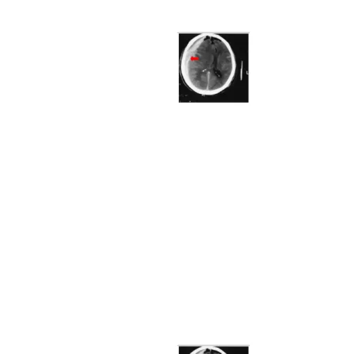 Gambar 13. Gambaran CT scan hematom subdural (Brunicardi, charles. Dkk. 2004)