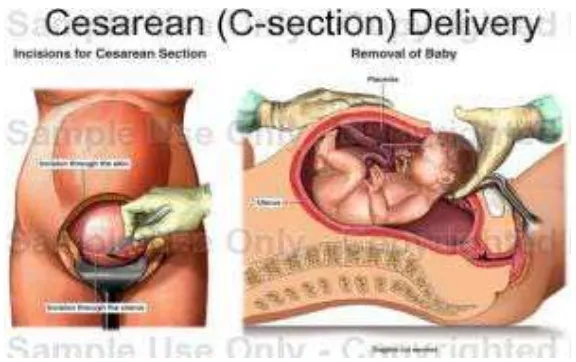 Gambar 2.1. Insisi Pembedahan Seksio Sesarea 