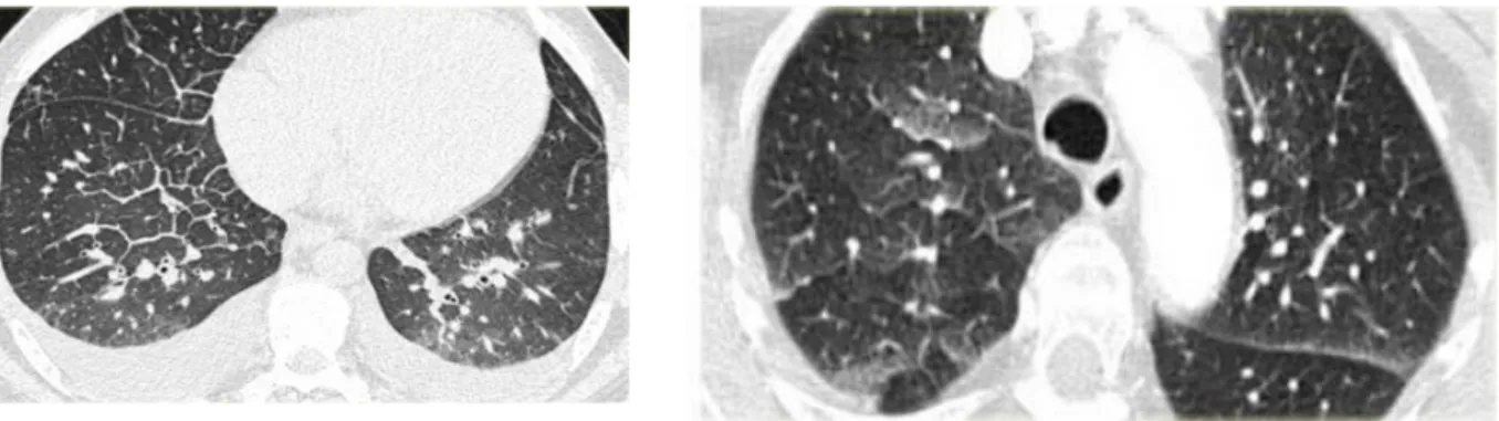Gambar 6. Gambaran CT-Scan edema paru kardiogenik Pada CT-Scan didapatkan gambaran: