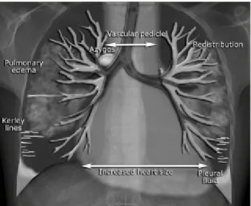 Gambar 2. Ilustrasi Radiologi Edema Paru Akut (Cremers, 2010)