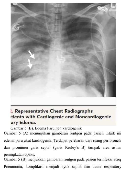 Gambar 5 (B). Edema Paru non kardiogenik