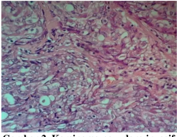 Gambar 2. Karsinoma payudara invasif  tipe duktal, grade 3 (dengan      pewarnaan Hematoxylin – 