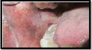 Gambar 7. Submukus Fibrosis Oral  