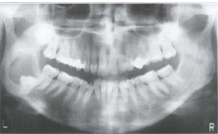 Gambar 6. Kista dentigerous yang meluar ke arah distal pada molar ketiga mandibula (White, 2000).