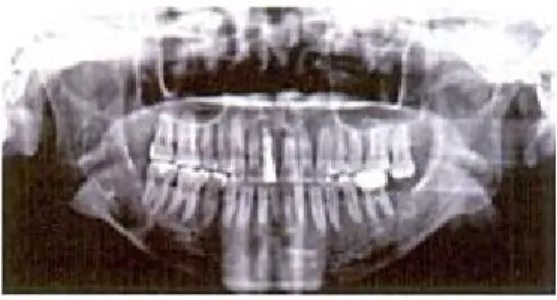 Gambar 9. Odontogenic keratocyst yang melibatkan mandibula (Ghom, 2008)