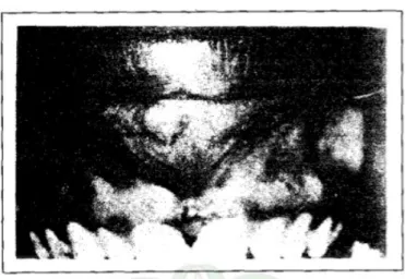 Gambar 13. Kista duktus nasopalatinus yang menyebabkan pembengkakan di garis tengah pada sisi labial alveolar ridge (Shear Mervyn