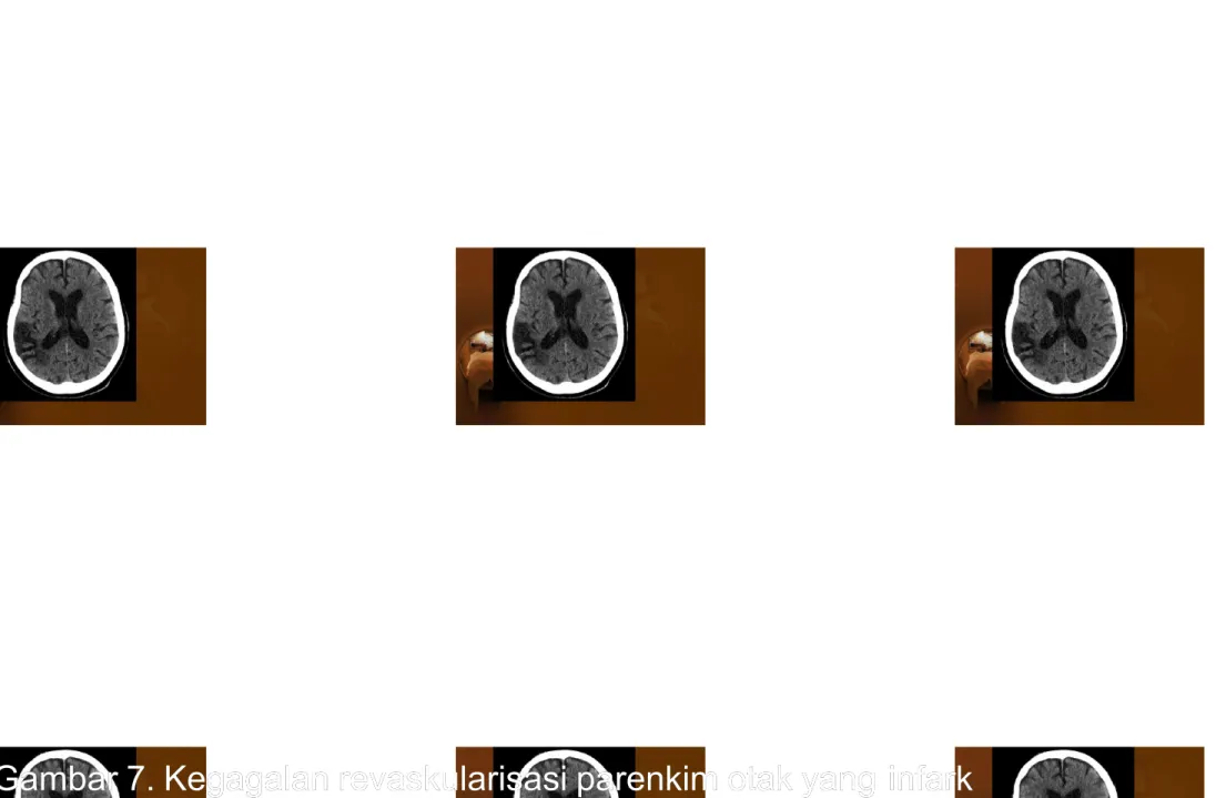 Gambar 7. Kegagalan revaskularisasi parenkim otak yang 