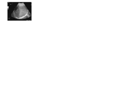 Gambar 4 : USG hepar dari laki  - laki 35 tahun setelah cedera tumpul abdomen  menunjukkan  koleksi  berbentuk  bulan  sabit  hyperechoic sepanjang  aspek  lateral  kanan  hati  konsisten  dengan  hematoma subcapsular.