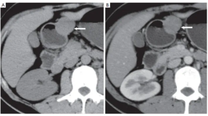 Gambar  14.    Wanita  41  tahun  dengan  schwannoma  gaster.  A.  CT  tanpa  kontras   memperlihatkan  massa  ekstraluminal    batas    tegas  dengan  densitas  homogen;   