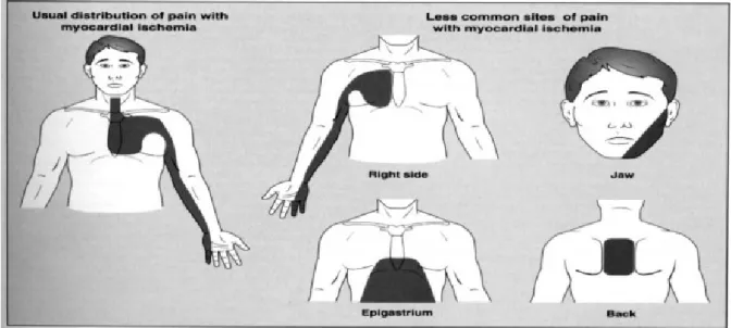 Gambar 2. pola nyeri pada pasien infark miokard akut