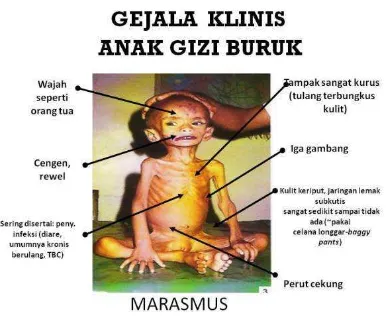 Gambar 2.1. Marasmus 