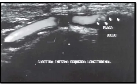 Gambar  21.  Gambaran carotid stenosis pada bagian kiri arteri karotid  dengan color doppler 1  