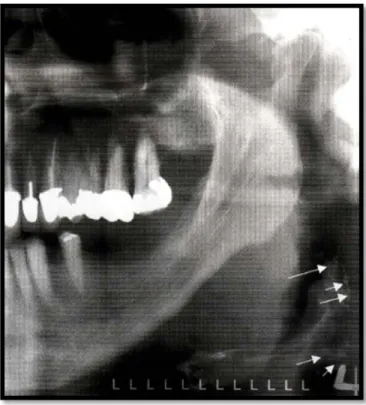 Gambar  13  . Identifikasi foto panoramik pasien laki-laki  berumur 64 th. Adanya garis  radiopak vertikal  pada jaringan lunak bagian kiri leher (tanda  panah) 18