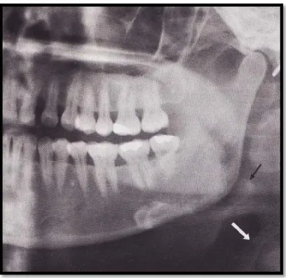 Gambar 15.     Gambar Epiglotis dan tiroid cartilage. Panah putih  menunjukkan aspek superior dari tulang tiroid  yang dianggap keliru sebagai kalsifikasi  pembuluh darah