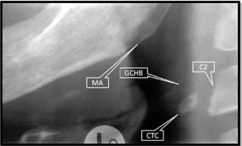 Gambar 16.    Gambar triceal cartilage. Potongan foto panoramik pada sudut  sebelah kiri mandibula (MA) memperlihatkan hubungan  antara kalsifikasi triticeous cartilage  (CTC) dengan tulang  hioid (GCHB) dan tulang kedua vertebra (C2) 20  
