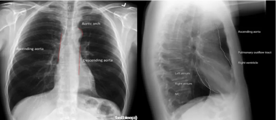 Gambar 5 Gambaran Regurgitasi Aorta