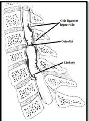 Gambar 5. Perubahan kelengkungan vertebrae Pencegahan
