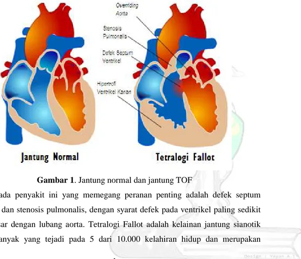Gambar 1. Jantung normal dan jantung TOF 